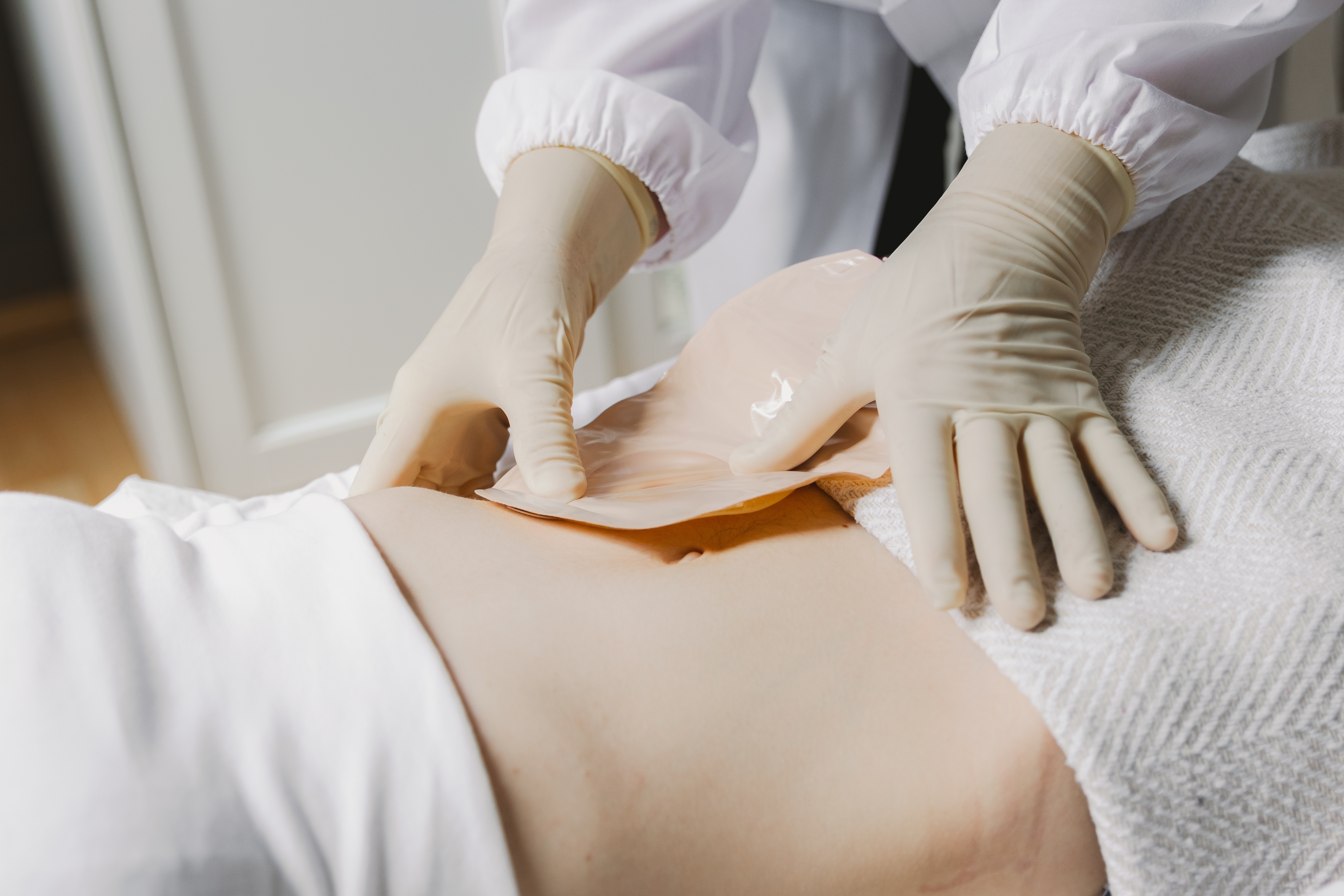 Enfermagem em Estomaterapia